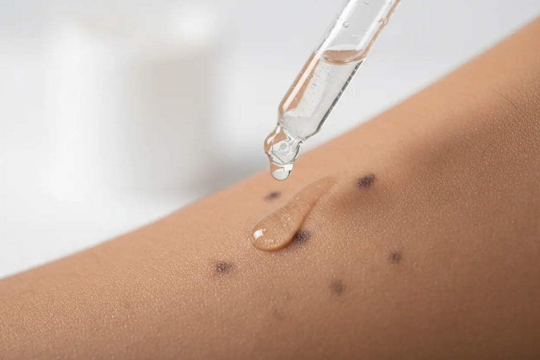 How to Remove Dark Spots on Face Fast at Home