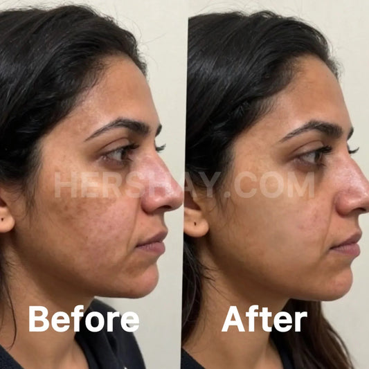 Understanding Hyperpigmentation: Causes, Prevention & Treatment - HERSHAY