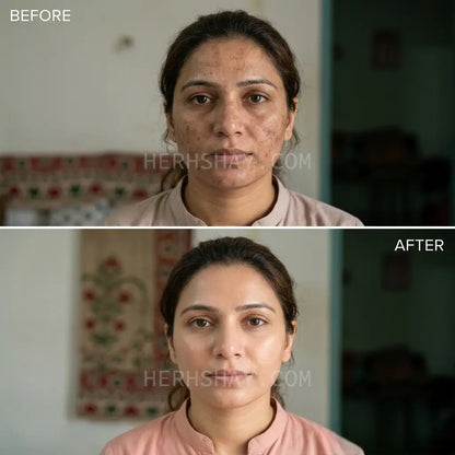 Hershay Before and after comparison of a woman's face with visible skin improvement.

