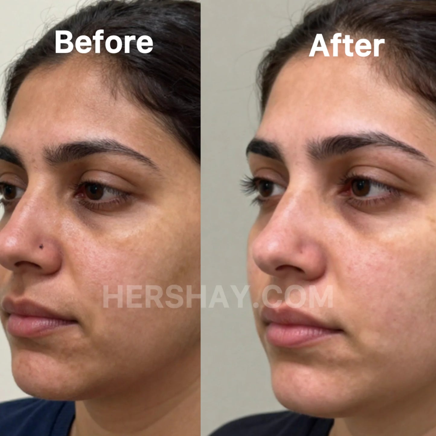 Before and after comparison of a woman's face with visible skin improvement.

