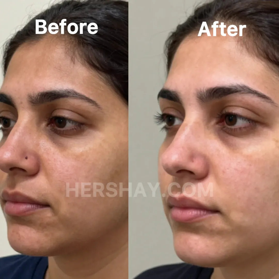 Before and after comparison of a woman's face with visible skin improvement.

