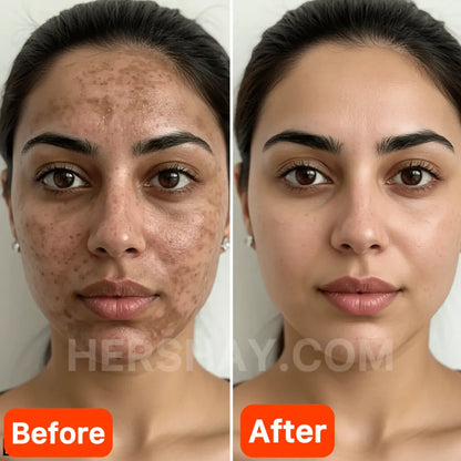 HERSHAY Before and after comparison of a woman's face with visible skin improvement.