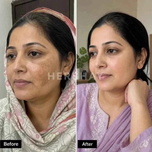 HERSHAY Anti-Pigmentation Cream | Best Melasma & Dark Spot Treatment in Pakistan