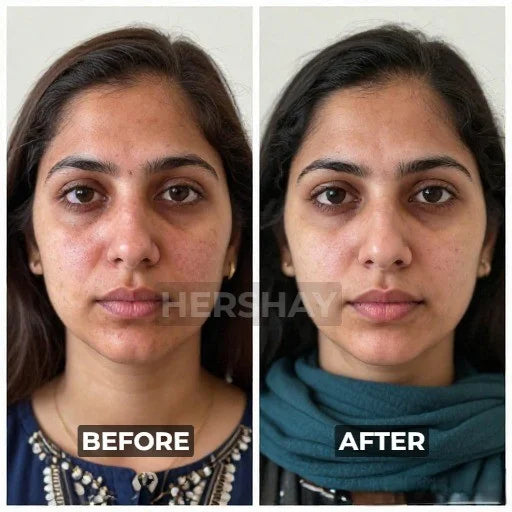 Before and after comparison of a woman with visible skin treatment results, branded 'Hershay'.

